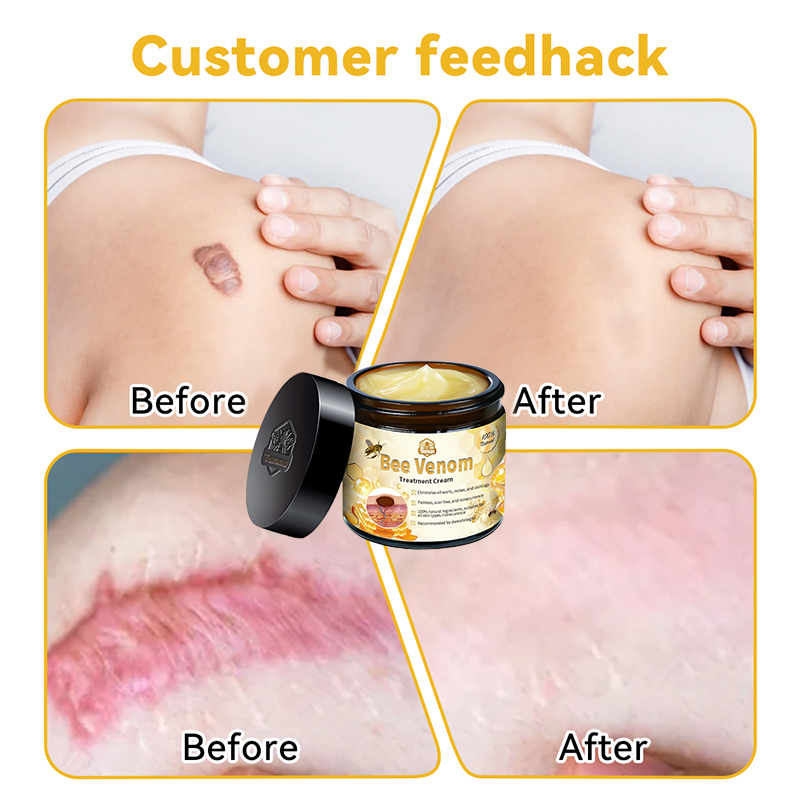 𝑇𝑢𝑟𝑜𝑛𝑢™ Bee Venom Skin Treatment Cream👩🏼‍⚕️（𝐴𝐴𝐷 𝑅𝑒𝑐𝑜𝑚𝑚𝑒𝑛𝑑𝑒𝑑） (🔥𝑳𝒂𝒔𝒕 𝒅𝒂𝒚 𝒑𝒓𝒐𝒎𝒐𝒕𝒊𝒐𝒏 80% 𝒐𝒇𝒇)